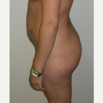 25-34 Year old Woman Treated with Brazilian Butt Lift (Fat Grafting) before 2150827