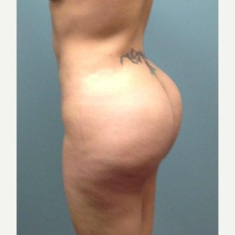 25-34 Year old Woman Treated with Brazilian Butt Lift (Fat Grafting) after 2150827