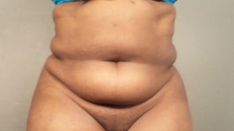55-64 year old woman treated with Tummy Tuck before 3497820