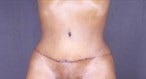 55-64 year old woman treated with Tummy Tuck after 3497820
