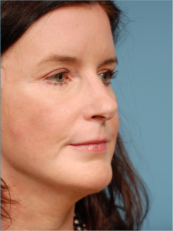 Face lift, Endoscopic Brow lift, Chin Augmentation and Upper Blepharoplasty after 518970