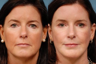 Face lift, Endoscopic Brow lift, Chin Augmentation and Upper Blepharoplasty 518970
