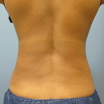 45-54 year old woman treated with CoolSculpting after 3763750