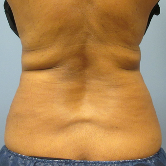 45-54 year old woman treated with CoolSculpting before 3763750