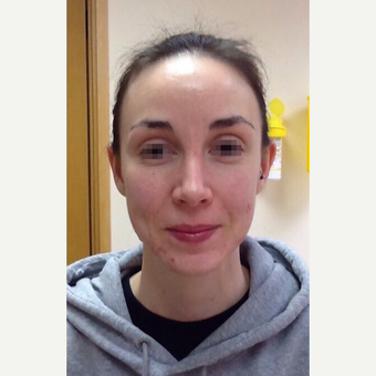 25-34 year old woman treated with Rhinoplasty after 3122813