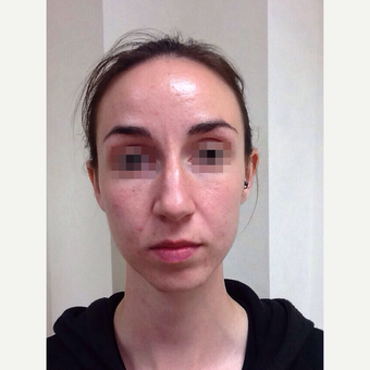25-34 year old woman treated with Rhinoplasty before 3122813