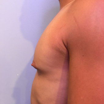 18-24 year old man treated with Male Breast Reduction before 3749844