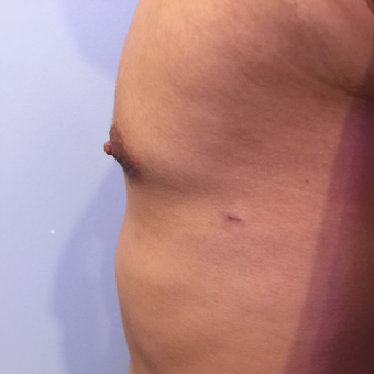 18-24 year old man treated with Male Breast Reduction after 3749844
