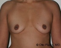 Fat Grafting for Breast Augmentation before 574488