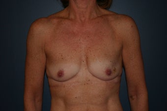 Immediate Breast Reconstruction before 1060939