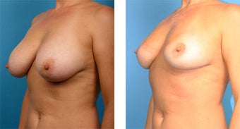 Breast Implant Removal with Internal Lift 562124
