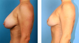 Breast Implant Removal with Internal Lift after 562124