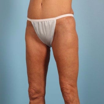 45-54 year old woman treated with Thigh Lift after 2378120