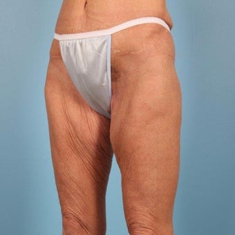 45-54 year old woman treated with Thigh Lift before 2378120