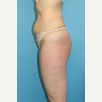 53 year old woman treated with Liposuction before 3582387