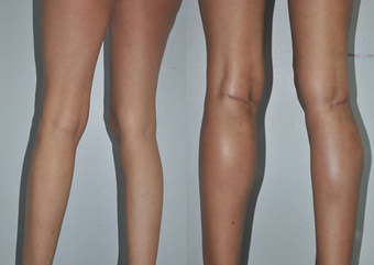 Calf Implants before 1111926