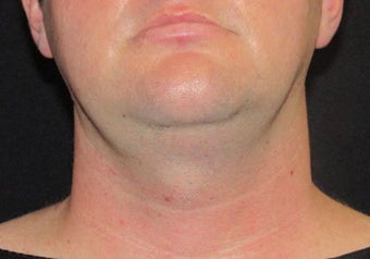 33 year old man treated with Necktite RFAL before 3683569