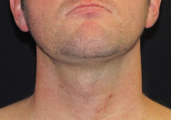 33 year old man treated with Necktite RFAL after 3683569