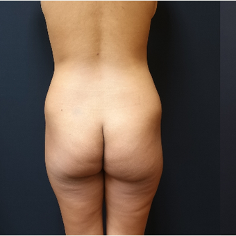 25-34 year old woman treated with Liposculpture before 3731879