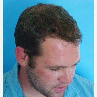 FUE Hair Transplant 1 Procedure Results 1761852