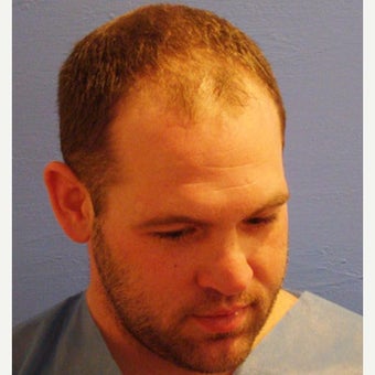 FUE Hair Transplant 1 Procedure Results 1761852