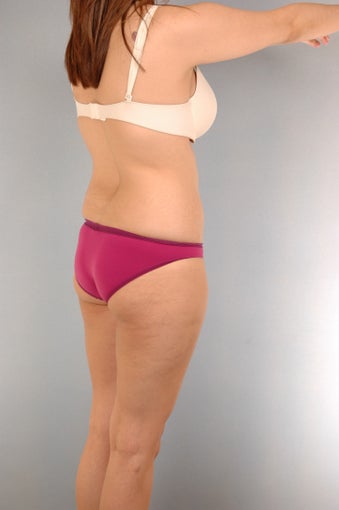 Liposuction and Brazilian Buttock Lift before 1232043