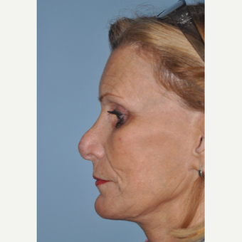 65-74 year old woman treated with Revision Rhinoplasty before 3332482