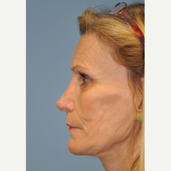 65-74 year old woman treated with Revision Rhinoplasty after 3332482