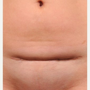 C-Section Scar Revision before 1698085