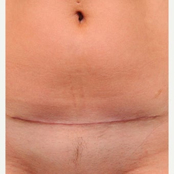 C-Section Scar Revision after 1698085