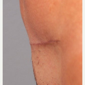 C-Section Scar Revision 1698085