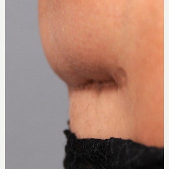 C-Section Scar Revision 1698085