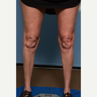 45-54 year old woman treated with Calf Implant before 2858226