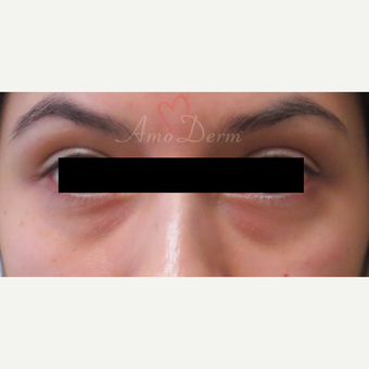 Patient treated with Restylane for dark circles under the eyes before 3357251