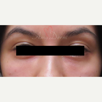 Patient treated with Restylane for dark circles under the eyes after 3357251