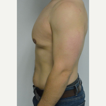 25-34 year old man treated with Male Breast Reduction before 3070587