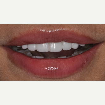 45 year old woman treated with Porcelain Veneers after 3543012