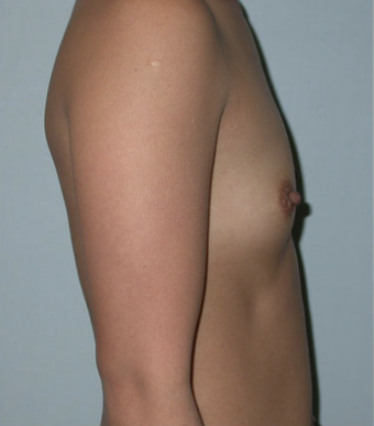 Breast Implants before 1071035
