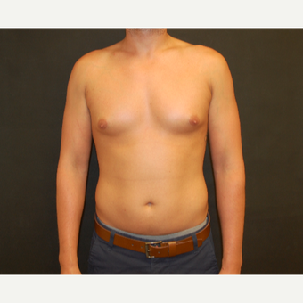 25-34 year old male treated with Male Breast Reduction before 3180922