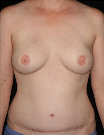 39 y/o - Immediate Bilateral DIEP Flap Breast Reconstruction after 1335757