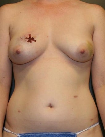 39 y/o - Immediate Bilateral DIEP Flap Breast Reconstruction before 1335757