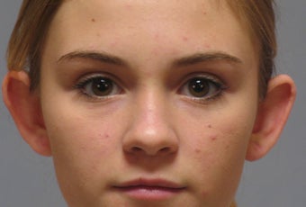 Otoplasty before 321105
