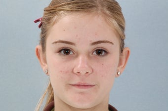 Otoplasty after 321105
