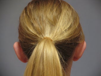 Otoplasty 321105