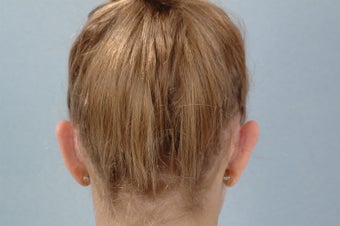Otoplasty 321105