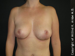 Female with Breast Implant Removal after 1129466