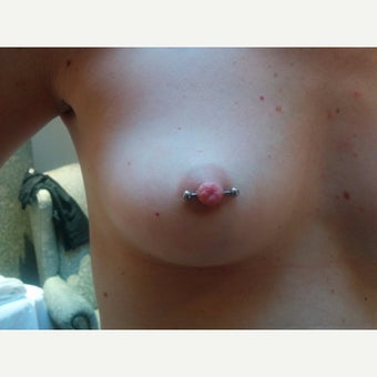 18-24 year old woman treated with medical piercing for correction of inverted nipple after 2377133