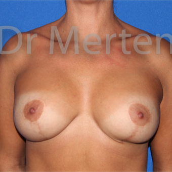 25-34 year old woman treated with Breast Lift with Implants after 3592510