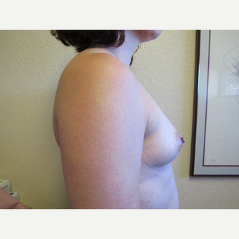 25-34 year old woman treated with Mentor Breast Implants before 3407186