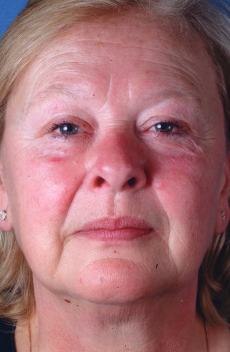 Photofacial (Intense Pulsed Light) after 660734